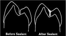 Sealants protect from decay!